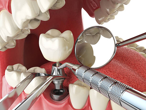 Best Emergency Dental Care for Sports Injuries in USA